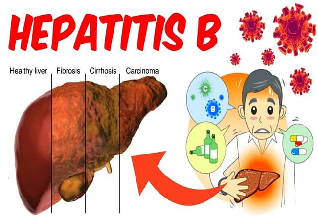 Hepatitis: 3,000 Ondo residents to get free screening